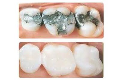 Fillings and Restorative Dentistry